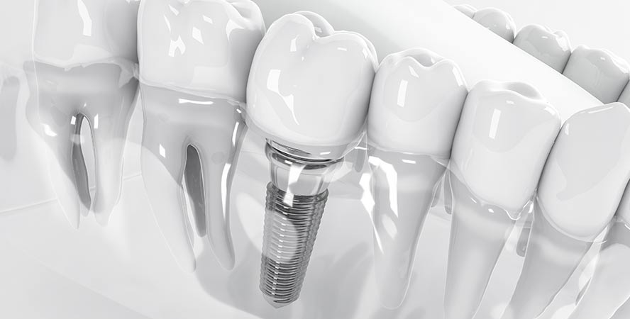 dental-implant
