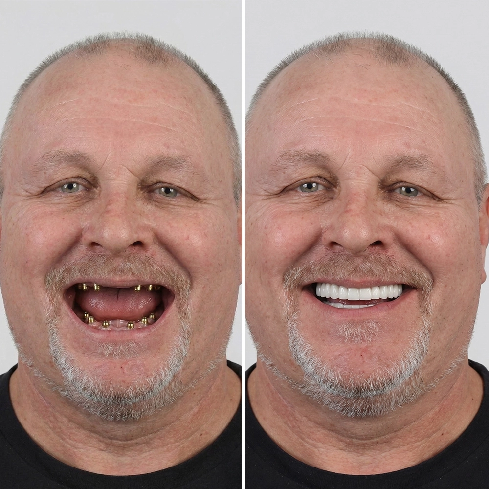 Implant Before After 2