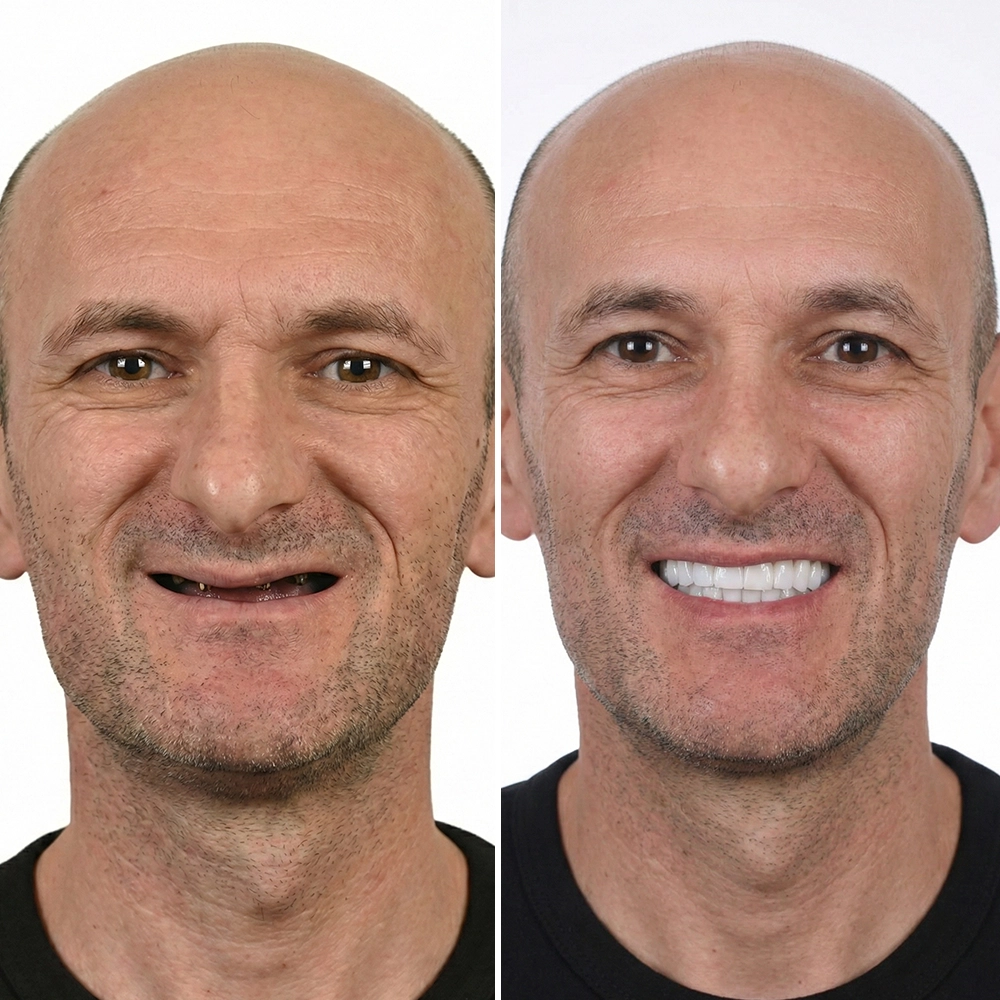 Implant Before After 3