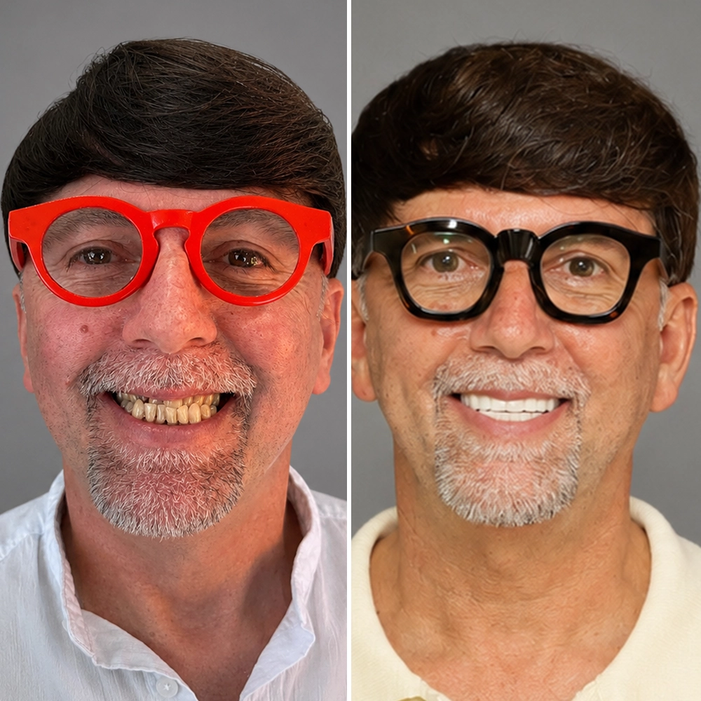 Veneers Before After 1